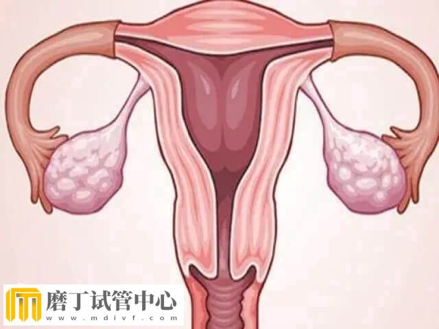 子宫疤痕憩室可不可以做试管婴儿(图1)